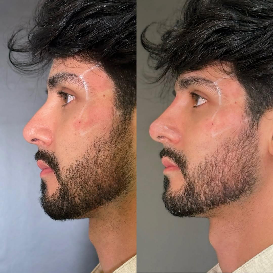Preenchimento de nariz 👃 Nosso famoso- Rinomodelação 👃😍😮_💨Apenas com ácido hialurônico e 30