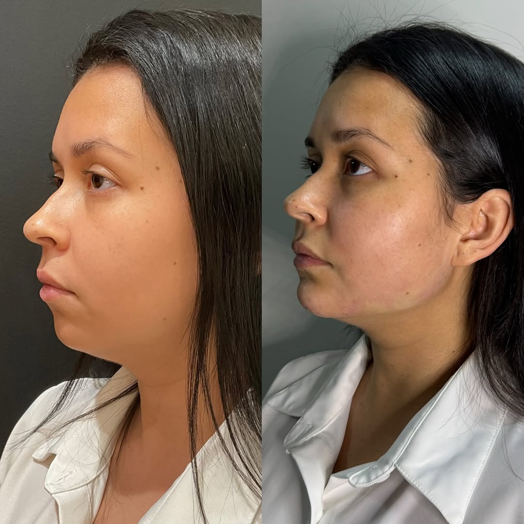 Você consegue ter uma mandíbula super natural, mas com o contorno definido! ✨💖